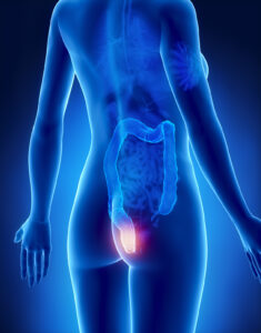 Female HEMORRHOIDS concept x-ray posterior view