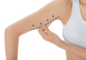 woman grabbing skin on her upper arm with the black color crosses marking, Lose weight and liposuction cellulite removal concept, Isolated on white background.