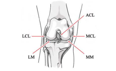 Najważniejsze więzadła kolana: MCL – więzadło poboczne piszczelowe, LCL – więzadło poboczne strzałkowe, ACL – więzadło krzyżowe przednie, PCL – więzadło krzyżowe tylne