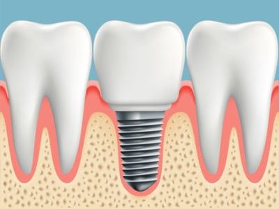 Human teeth and Dental implant. Stock vector illustration.