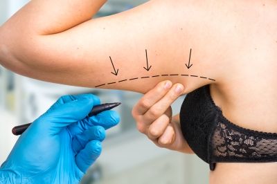 Plastic surgery doctor draw line on patient arm